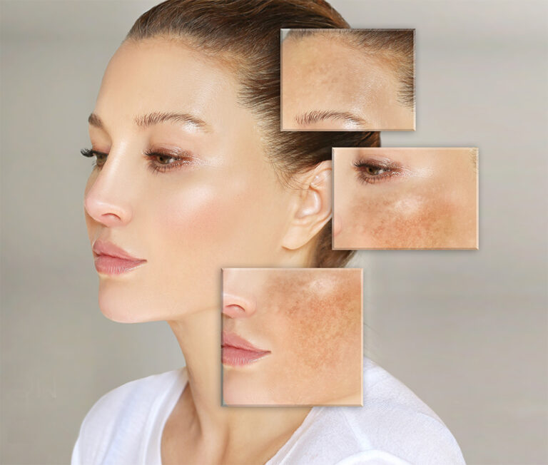 Trị Nám Tàn Nhang